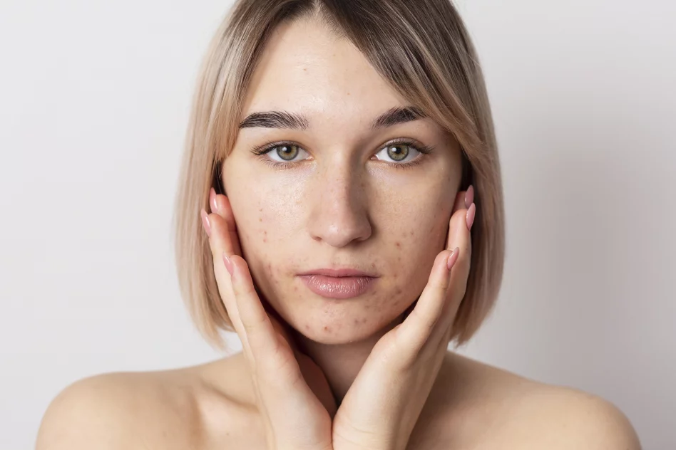 The Best Treatments for Acne Scars: Peptides, Exosomes, and More