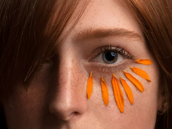 Revealing the Secret to Radiant Eyes: Dermal Fillers for Tear Trough Rejuvenation